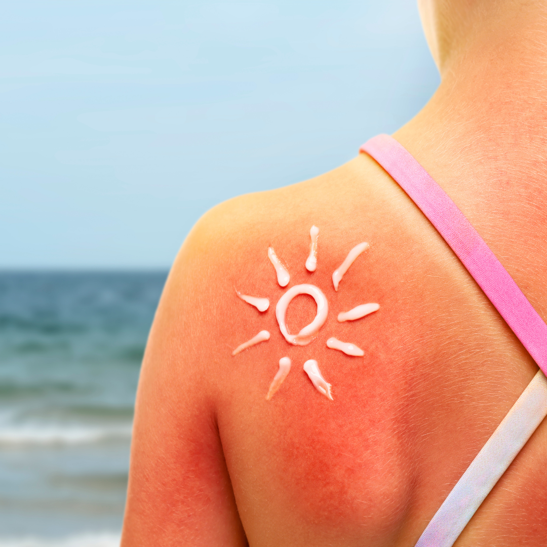 What to Do If Your Kid Gets Sunburned (Sunburn Relief & After-Sun Care for Kids)